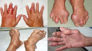  Bệnh Gout đến từ đâu